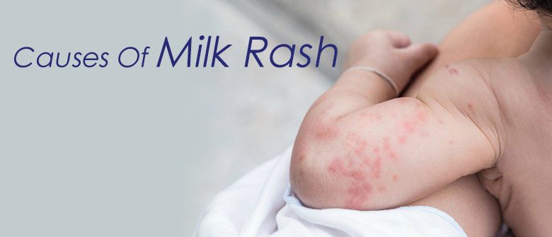 Causes of Milk Rash - Cussons Baby Nigeria
